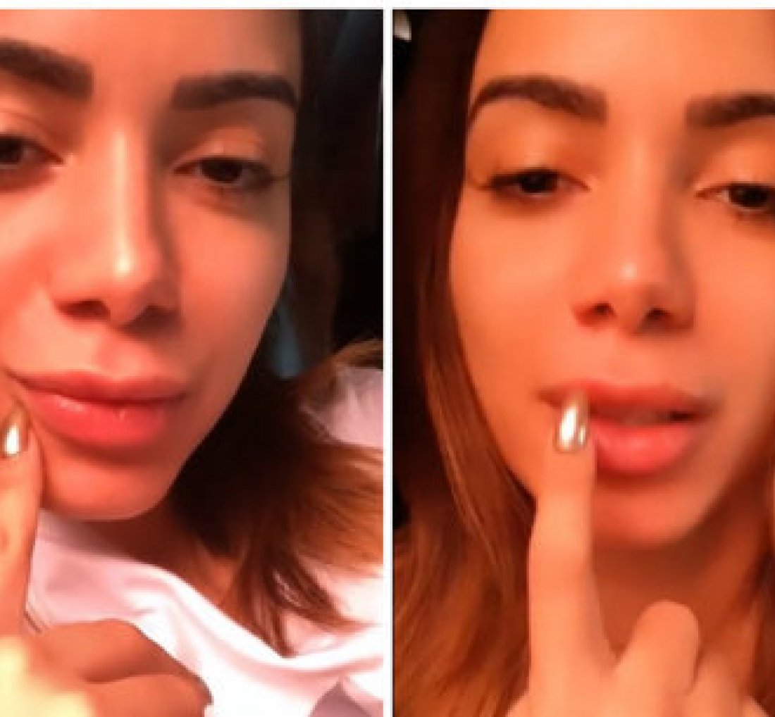 [Anitta faz preenchimento labial inspirado em filtro do Instagram]